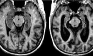 Other Dementias