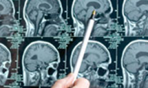 What is Dementia?